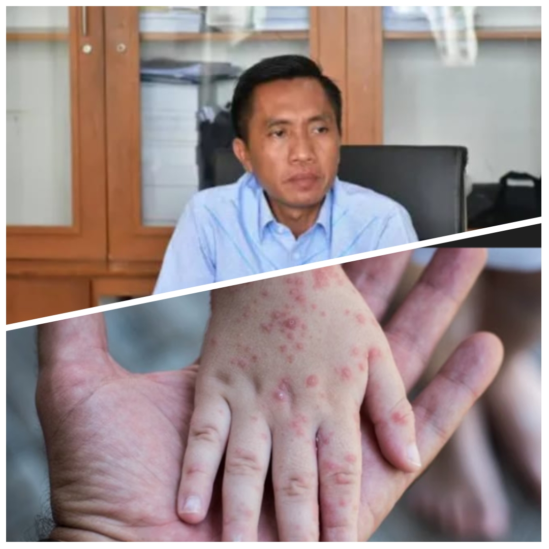 Kasus Campak Meningkat, Komisi IV DPRD Kota Bandarlampung Desak Pemkot Audit Data Cakupan Imunisasi